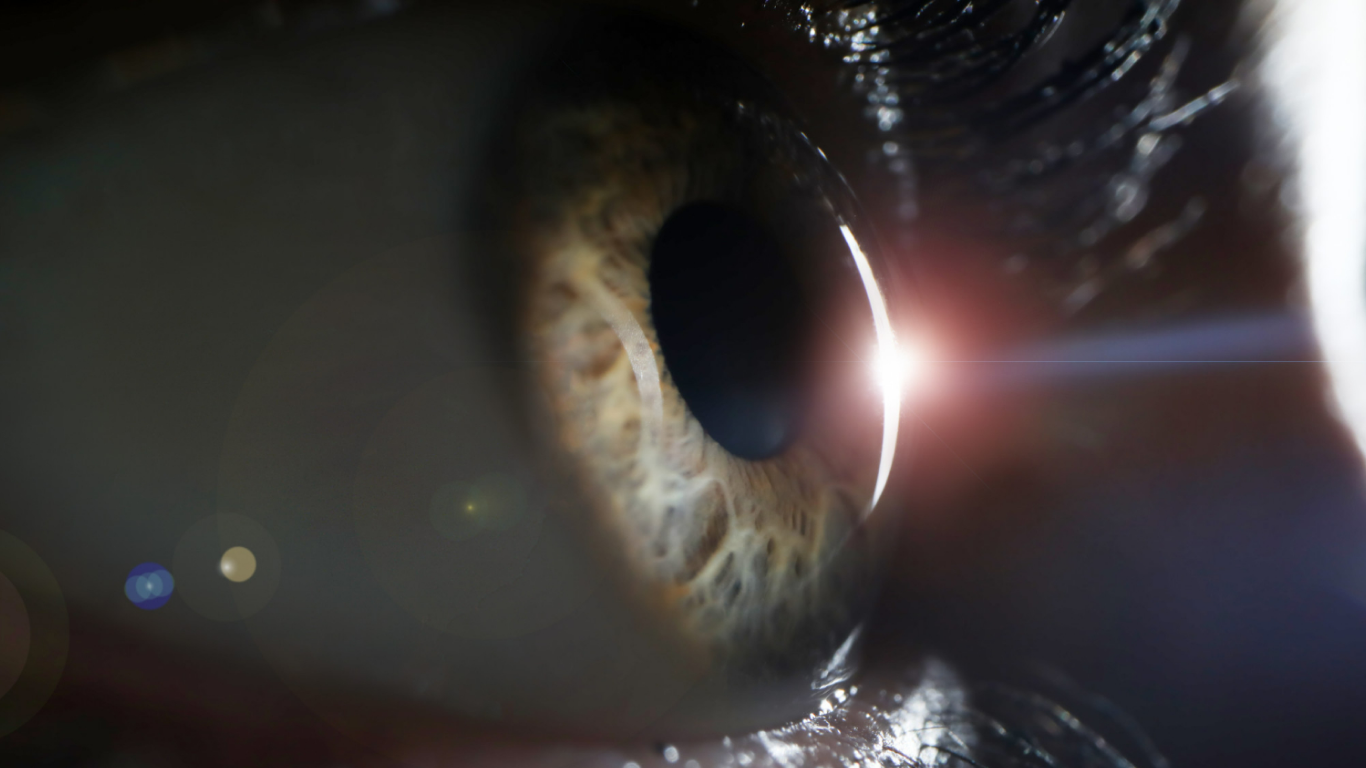 Olho passando por cirurgia refrativa.